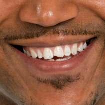 Man smiling with chipped tooth