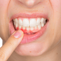 A person pointing to bleeding gums