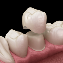 A smile with dental crowns